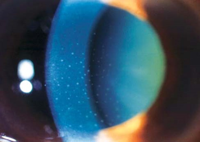 File:Figure 4 Slit Lamp Photo Keratic Precipitates.jpg