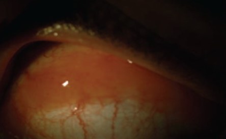 File:Conjunctival RLH - Figure 1.jpg