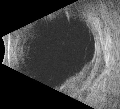 File:B-scan extrascleral extension presentation.jpg