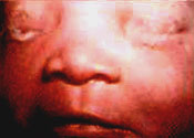 Neonatal Conjunctivitis