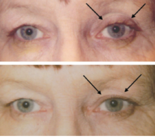 Fig 14: Patient initially on bimatoprost OS (top) and six weeks after discontinuation of medication (bottom). Note the re-appearance of baseline pre-existing dermatochalsis.