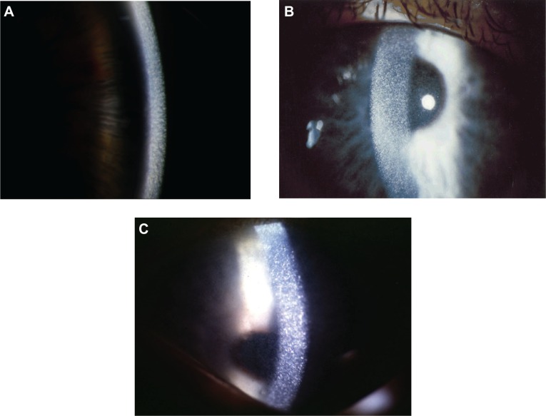 File:Corneal cystinosis.jpg