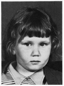 Duane Retraction Syndrome of Left Eye with Compensatory Head Tilt