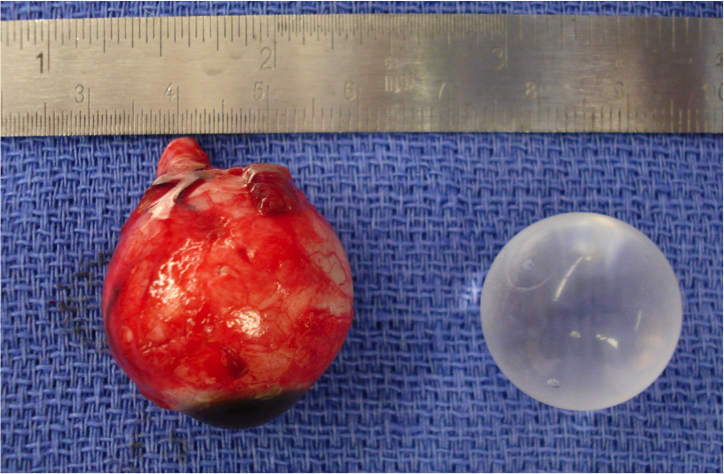 File:Enucleation Implant Sizing.png
