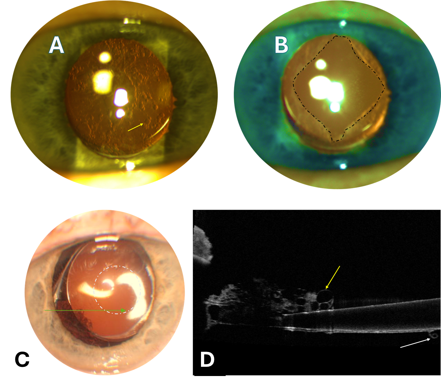 Clinical and imaging findings in posterior capsule opacification (PCO). A. Retroillumination image showing multiple Elschnig pearls involving the optical zone and visual axis; the yellow arrow indicates pearl-type PCO. B. Appearance after Nd:YAG laser posterior capsulotomy with a central cruciate opening, outlined by the dashed black line. C. Anterior segment photograph showing an open posterior capsule with residual Elschnig pearls; the dashed white circle marks the capsulotomy opening. D. Anterior segment OCT showing cystic hyporeflective spaces consistent with Elschnig pearls; the yellow arrow indicates Elschnig pearls and the white arrow indicates the rolled posterior capsule at the edge of the capsulotomy. Courtesy of Joobin Khadamy, MD, FEBO. Previously published in: Khadamy J. Efterstarr (Posterior Capsule Opacification, PCO). Internetmedicin. Revised April 12, 2026. Available at: https://www.internetmedicin.se/ogonsjukdomar/efterstarr-posterior-capsule-opacification-pco