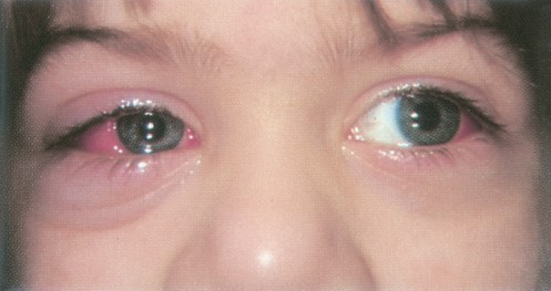 File:Orbital cellulitis.jpg