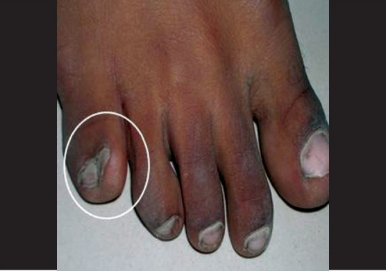 File:Accessory toe with syndactily with 5th digit of right foot.jpg