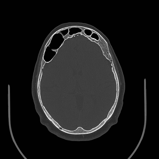 File:Pneumosinus dilatans R frontal sinus.jpg
