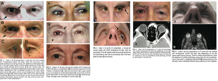 Fig 2: Second case report of 5 patients showing PAP, courtesy of Filippopoulos et al.