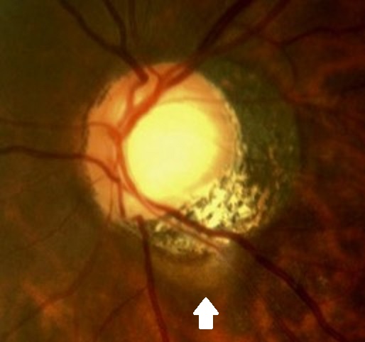 File:Picture 1- fundus picture..jpg