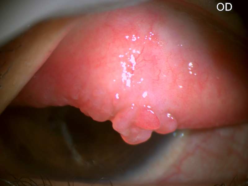 File:Patient in India with vernal keratoconjunctivitis.png