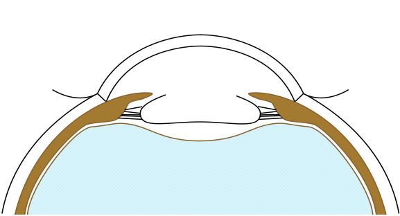 File:Anterior capsulorhexis.png