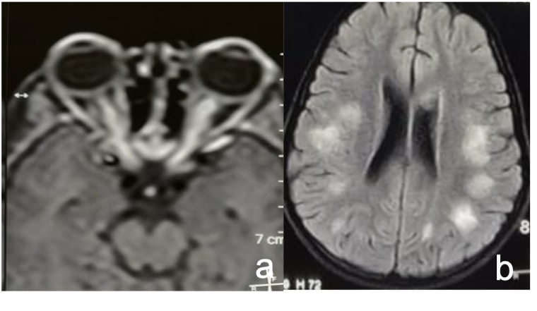 File:Optic neuritis.png