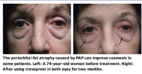 Fig 17: Patient who displayed a mild reduction in prominence of lower lid fat after bilateral bimatoprost therapy.