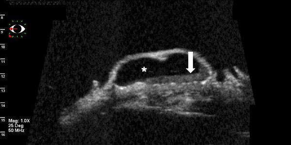 File:UBM cross-section of conjunctival cystic lesion.jpg
