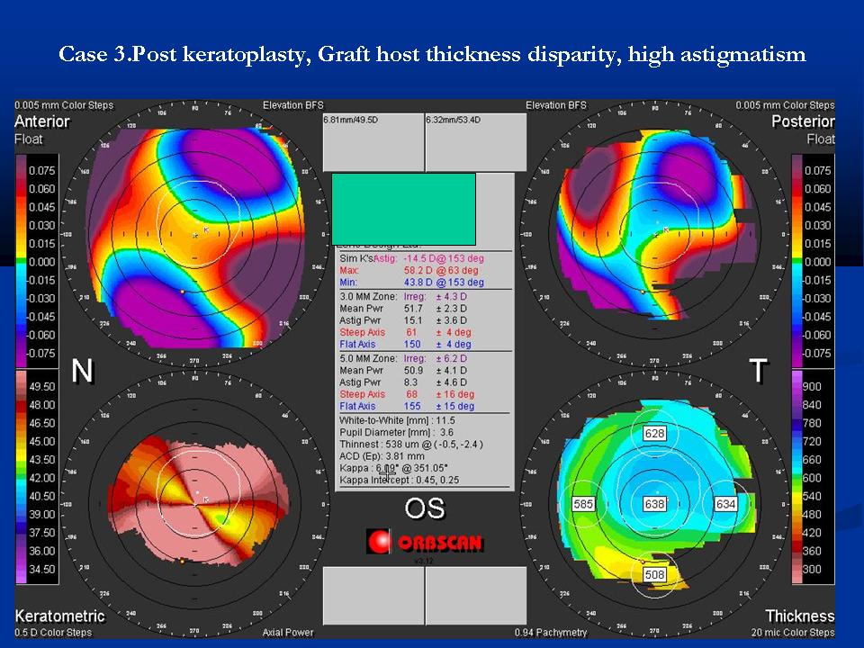 Posterior Float Keratoconus