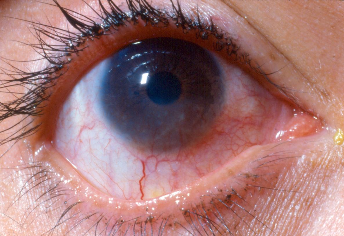 Staphylococcal phlyctenular keratoconjunctivitis