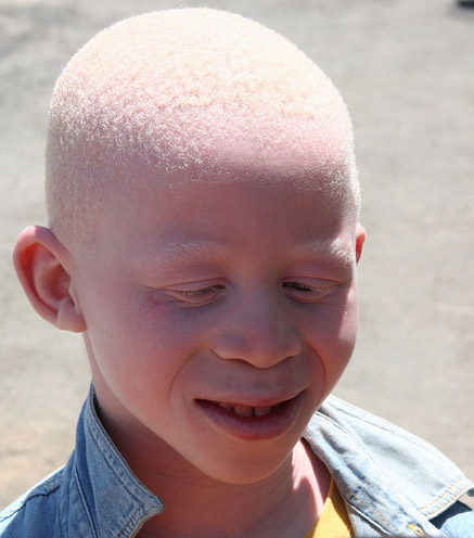 Albinism portrait