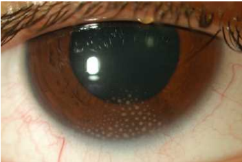 Arlt's Triangle - EyeWiki