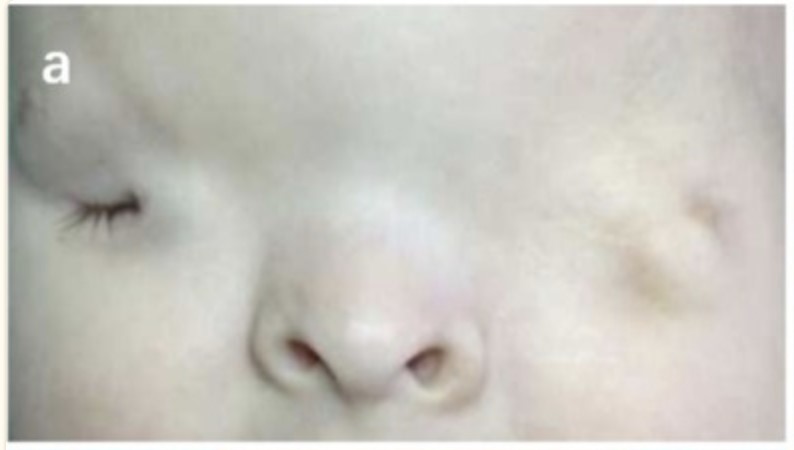 File:Cryptophthalmos complete OS incomplete OD.jpg