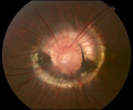 File:AAO Morning glory fundus.jpg