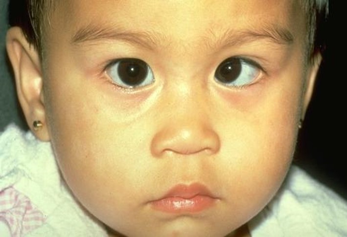Amblyopia. Strabismus is the most common underlying cause of amblyopia. With constant deviation of one eye, reduced vision occurs. Amblyopia is less likely when the deviation is intermittent or when the two eyes alternate fixation.