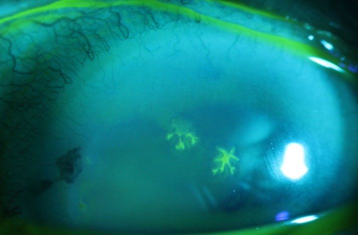 File:Figure 6 Slit Lamp Photo HSV Dendrite.jpg