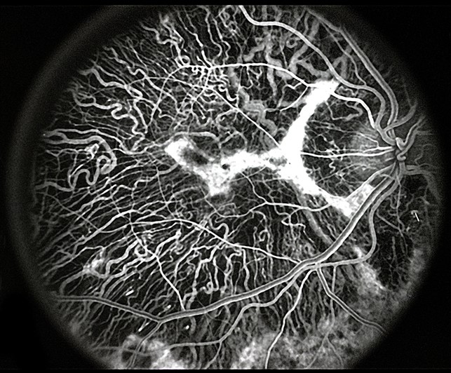 File:Choroideremia Figure 4.jpg