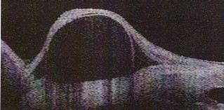 File:Cisto Conj OCT Longitudinal.jpg