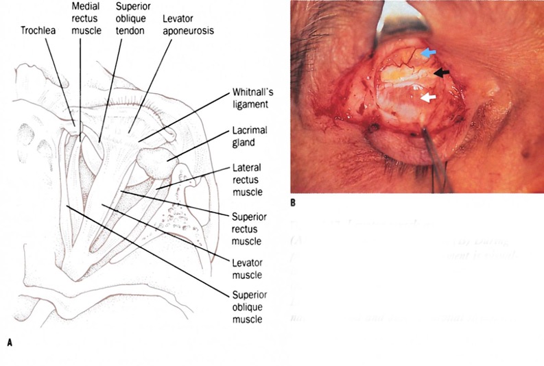 File:Whitnall's ligament.jpg