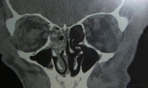 Right orbit medial wall fracture. Courtesy of Damien Luviano, MD, FACS.