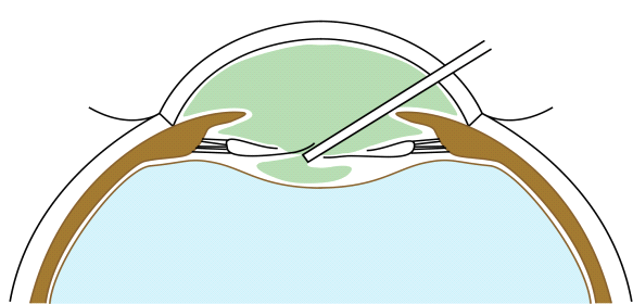 File:Filling the Berger space.png