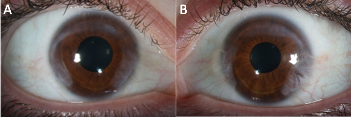 File:Fuchs' Superficial Marginal Keratitis clinical image.jpg