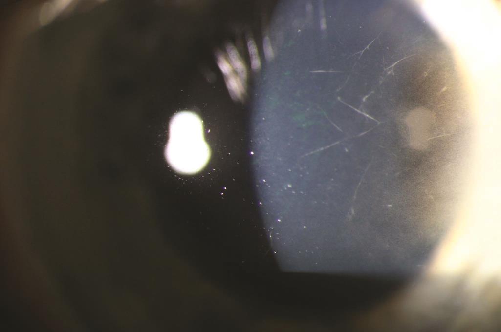 Slit lamp photograph of corneal nerves (Courtesy of Colleen Halfpenny, MD.)