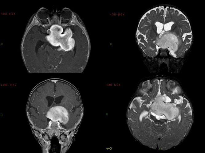 File:Glioma monocular nystagmus.jpg