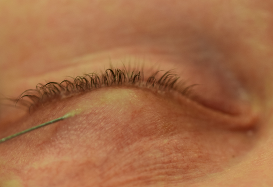 File:MMCR Eyewiki Figure 1.png