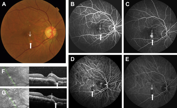 File:Xu - Focal Choroidal Excavation.jpeg