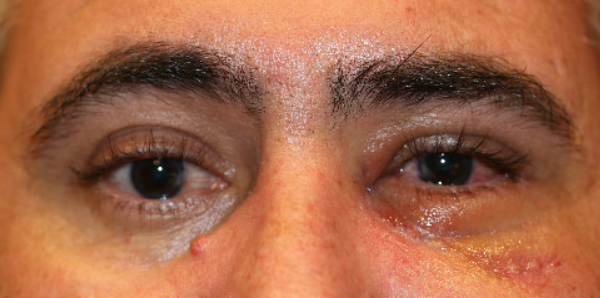 File:MCT Avulsion NOE FracturePost.png