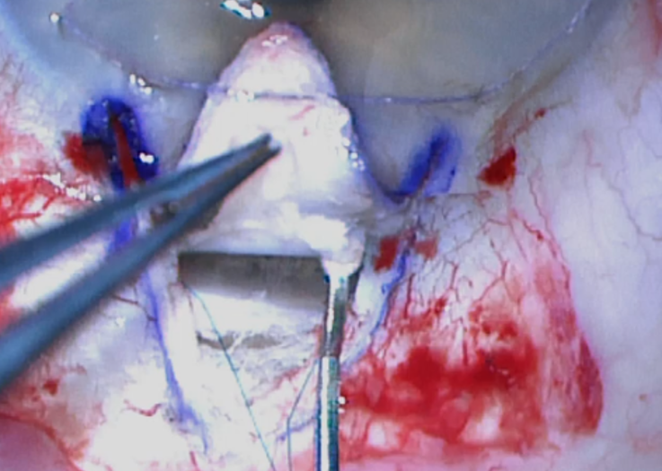 File:Detaching schwalbe's line.png