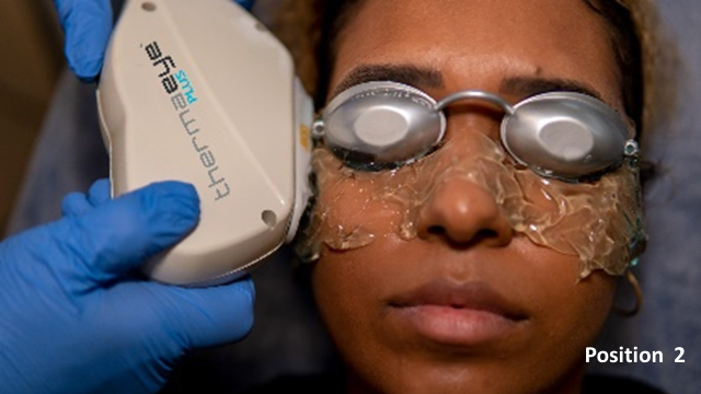 File:IPL treatment B2.png