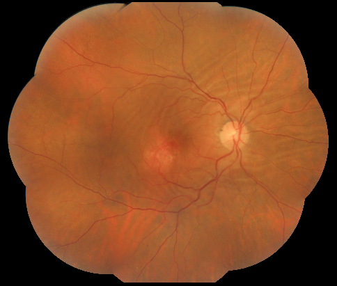 File:Choroidal Folds Retinography.png