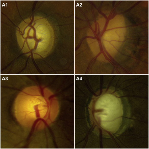 File:Optic discs with and without tilt.jpg