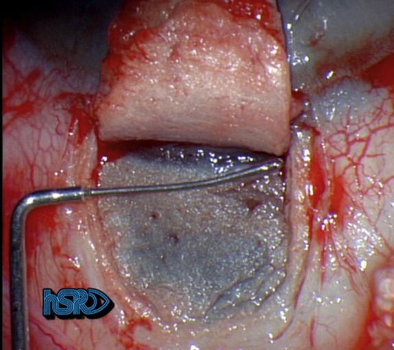 File:Viscocanalostomy.png