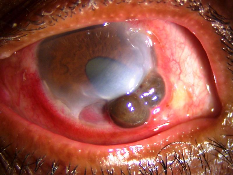 File:Patient in India with Peripheral ulcerative keratitis .jpg