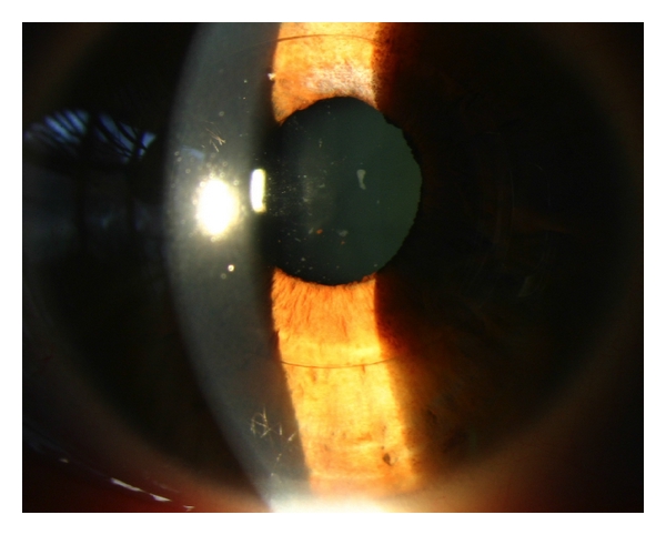 File:Iris claw AC inflammation.jpg