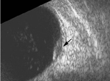 File:Choroidal excavation.jpg
