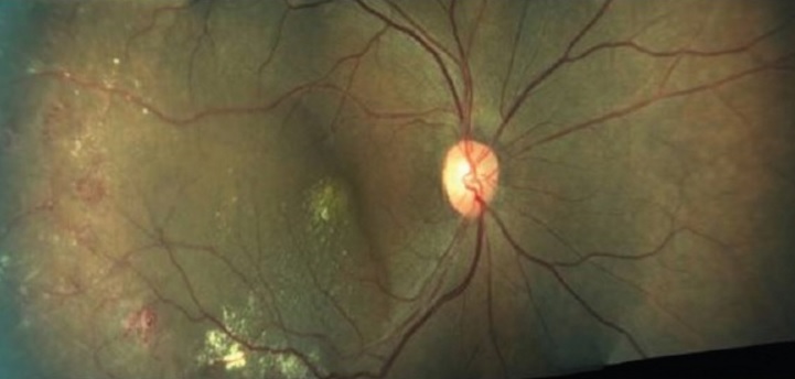 File:Coats disease.jpg