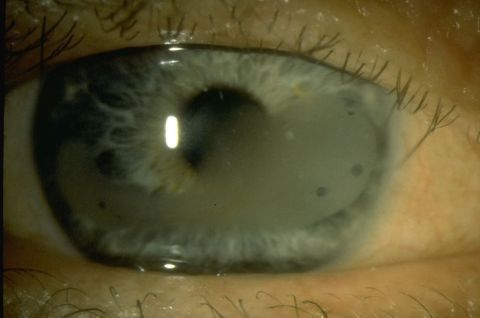 Calcific Band Keratopathy