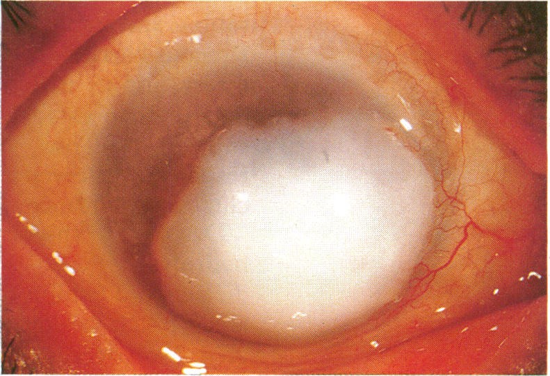File:Corneal keloid gross appearance.jpg