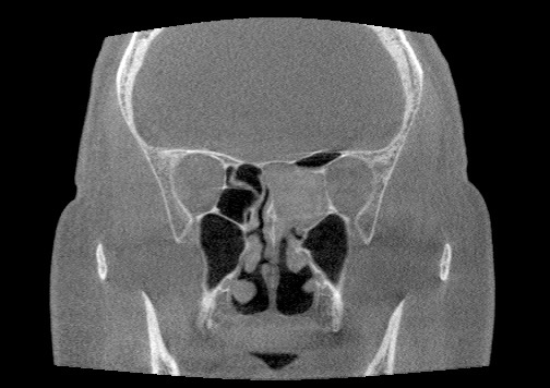 File:CT Coronal.jpg